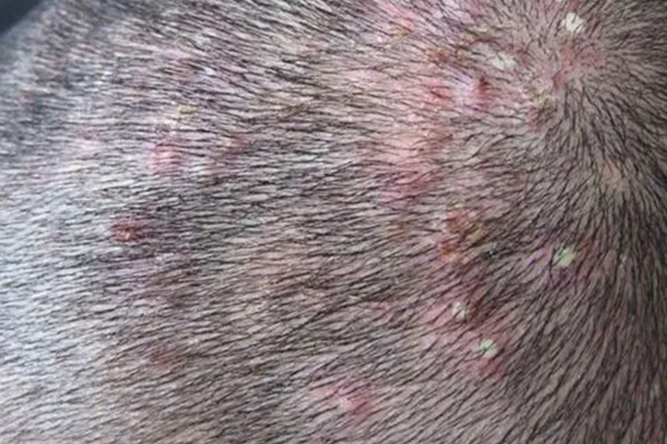 老年人头上毛囊炎图