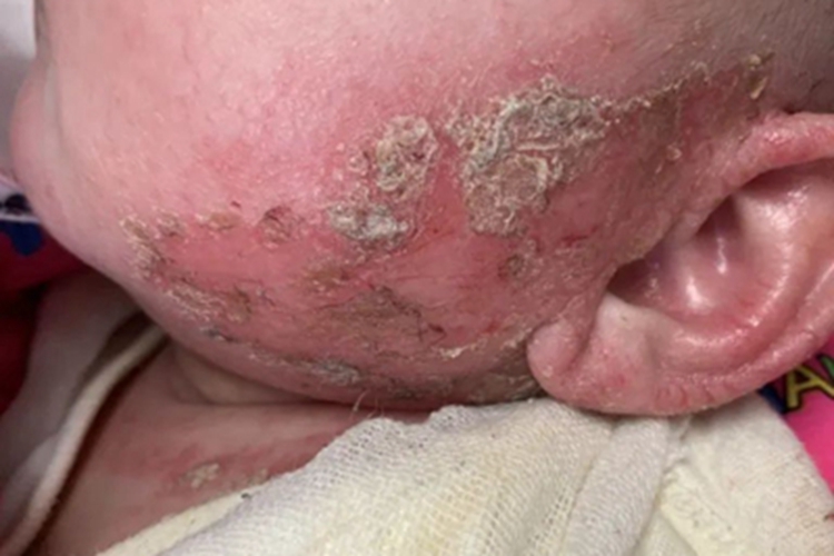 婴儿期特应性皮炎面部黄痂图 婴儿期特应性皮炎面部黄痂图