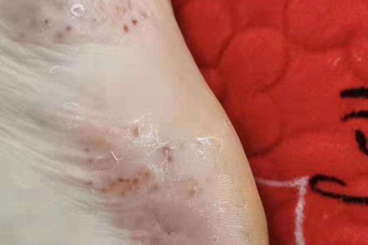 掌跖脓疱病脚底有结痂图 掌跖脓疱病脚底有结痂图