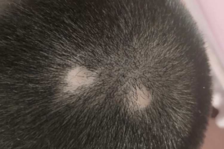 脱发性毛周角化病头皮症状图