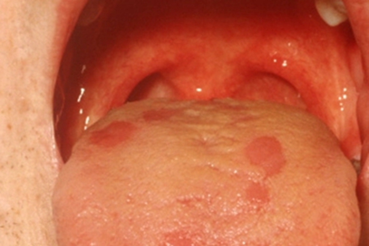 二期口腔梅毒口腔红斑图