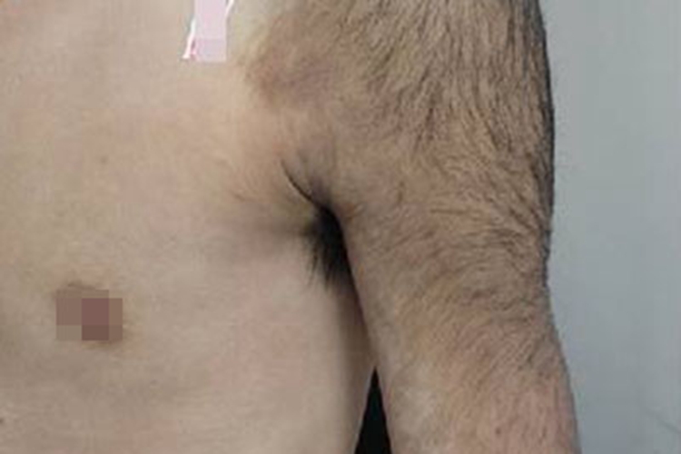 贝克痣胳膊毛发过长图