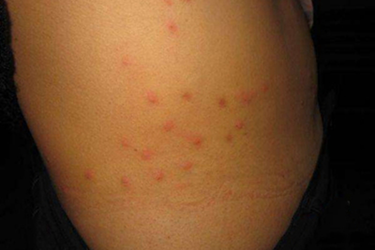 成人痒疹腰部红疙瘩图 成人痒疹腰部红疙瘩图