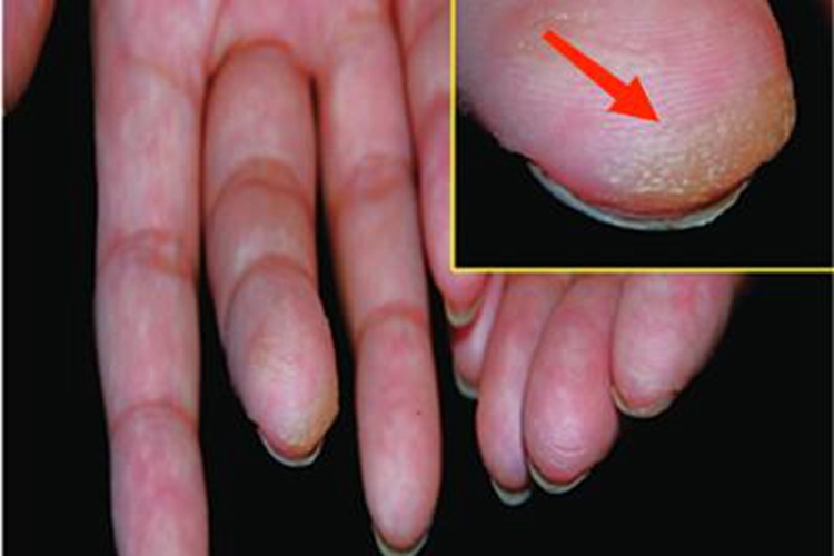 酪氨酸血症Ⅲ型皮肤发黄图