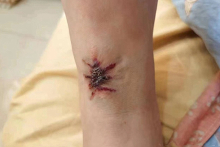 疣状血管瘤小腿结节图