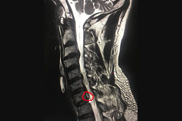 颈椎6一7突出位置图