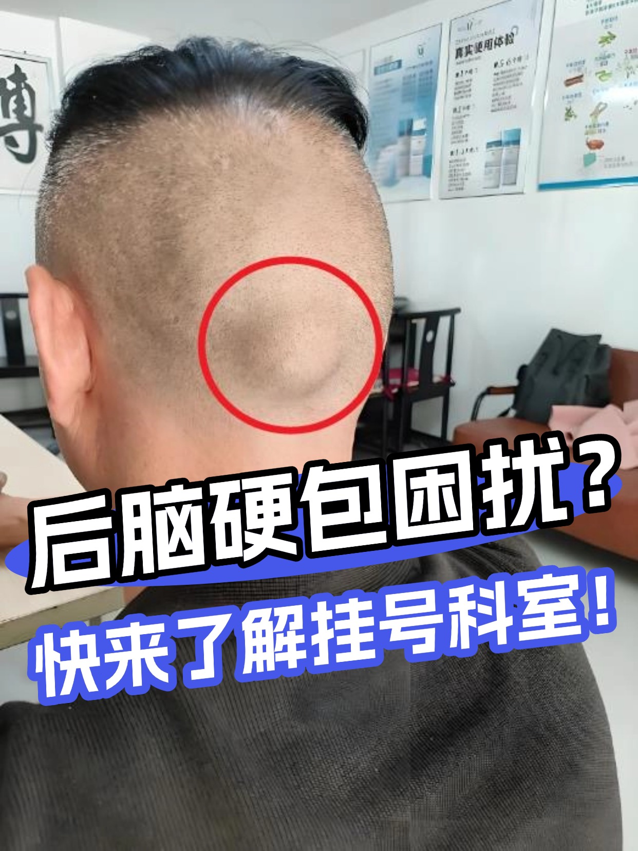 后脑硬包困扰?快来了解挂号科室!