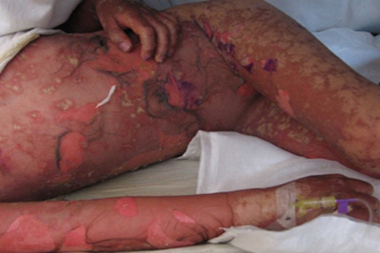 大疱性表皮松解症全身脱皮图