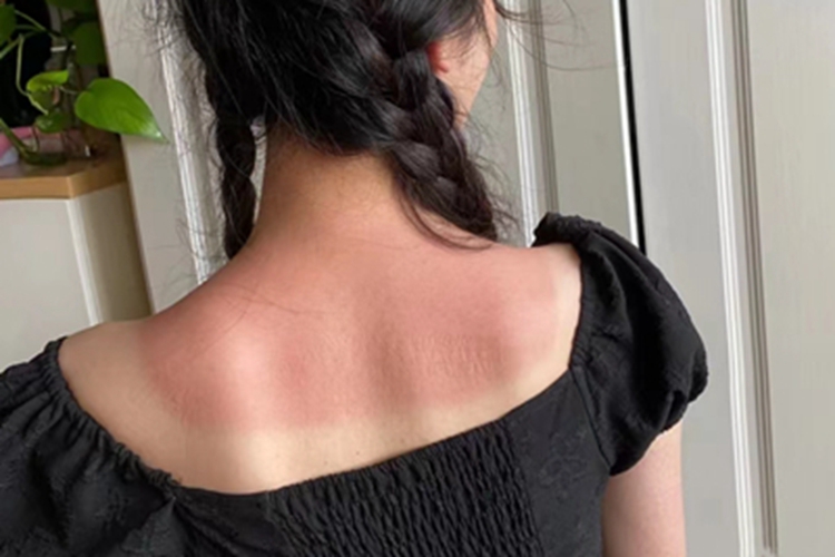 日晒伤肩部红斑图