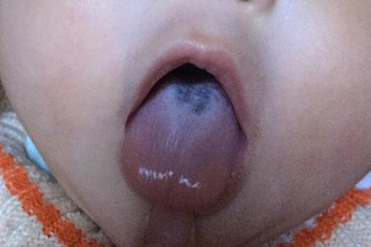 黑毛舌舌苔发黑图 黑毛舌舌苔发黑图