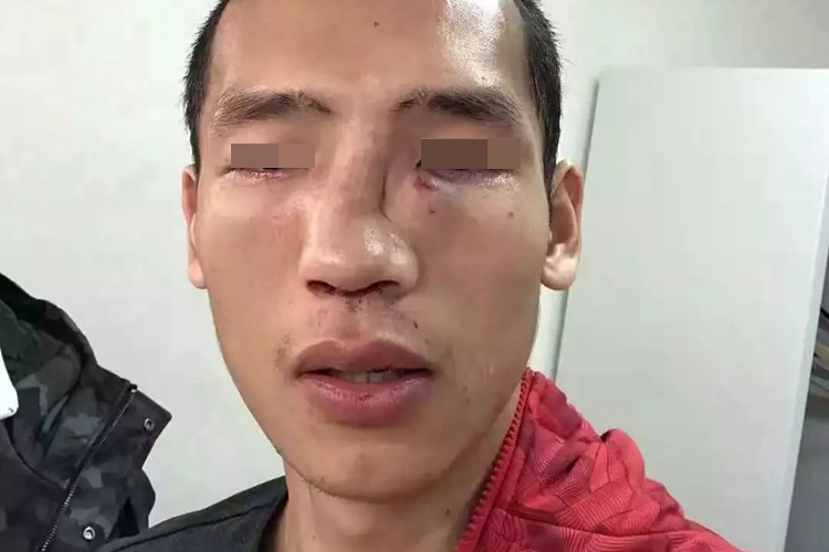 外伤畸形鼻子图