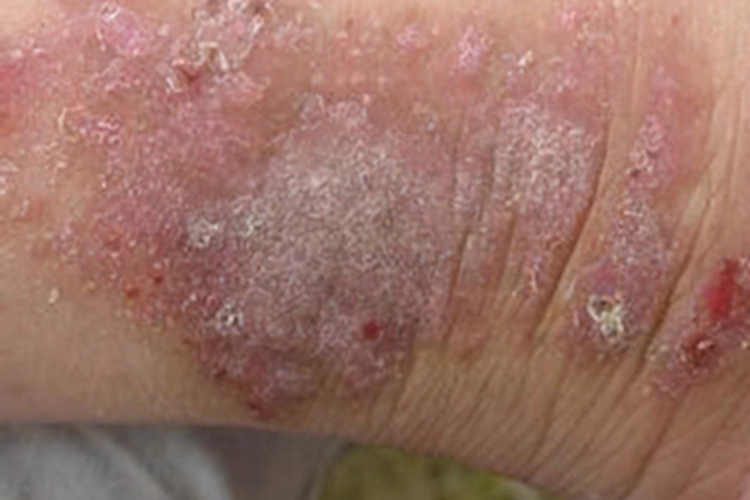 急性湿疹脚踝脱屑图