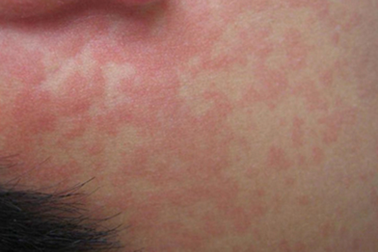 典型麻疹出疹期耳后红斑图 典型麻疹出疹期耳后红斑图