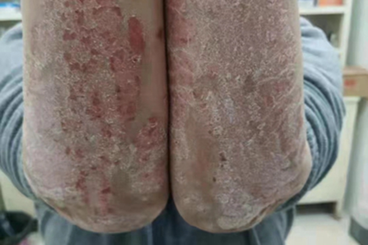 慢性湿疹胳膊脱屑图 慢性湿疹胳膊脱屑图