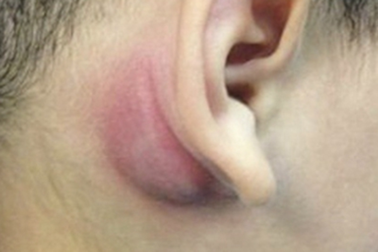 第一鳃裂瘘管耳后包块图