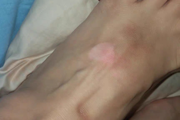 白癜风脚背白斑图 白癜风脚背白斑图