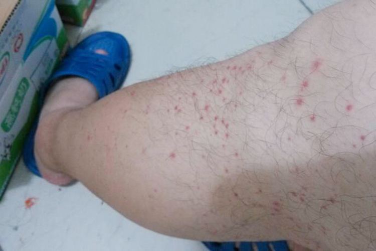 大腿丘疹性梅毒疹图