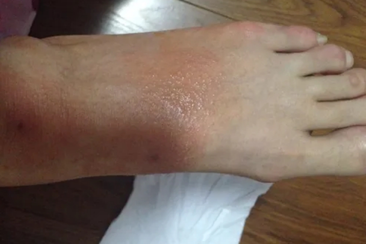 血吸虫尾蚴皮炎脚背出现小水疱图 血吸虫尾蚴皮炎脚背出现小水疱图