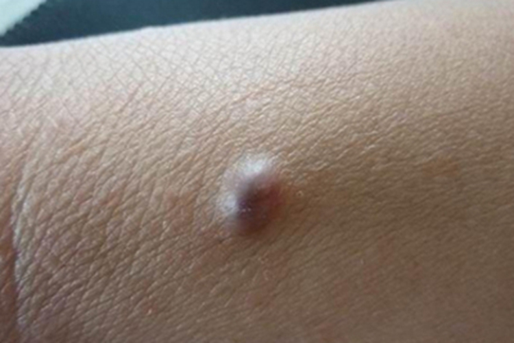 皮肤肥大细胞瘤症状图 皮肤肥大细胞瘤症状图