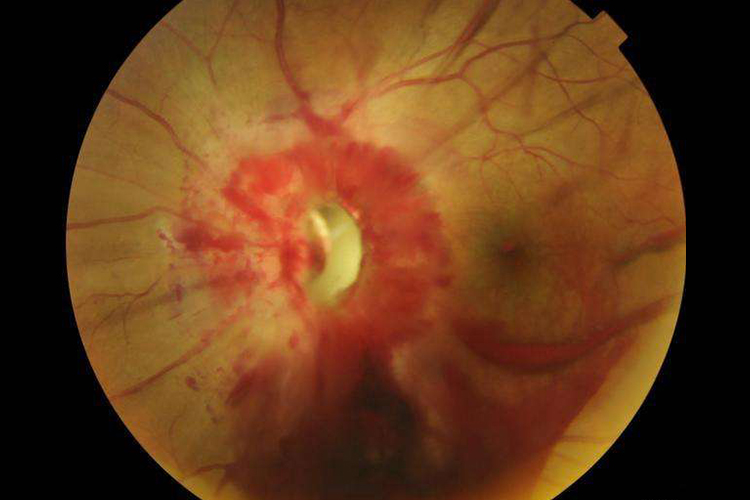 小孩视神经撕脱图