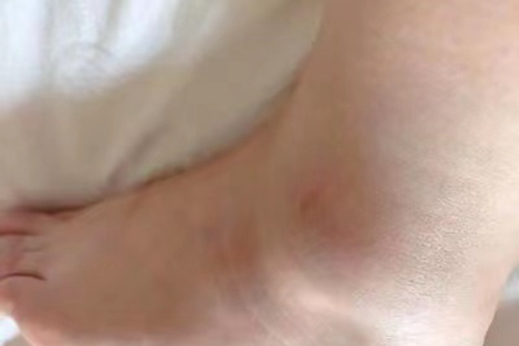 踝扭伤脚踝肿起来了图