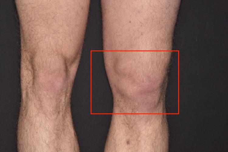 外伤性左侧髌骨外翻图