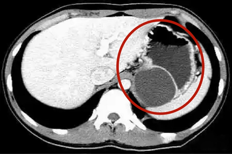 胃囊肿腹部CT影像图