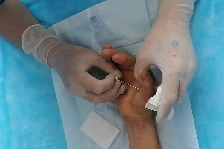 拇指腱鞘炎封闭治疗注射点图