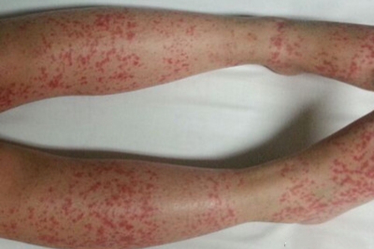 高球蛋白血症性紫癜小腿症状图 高球蛋白血症性紫癜小腿症状图