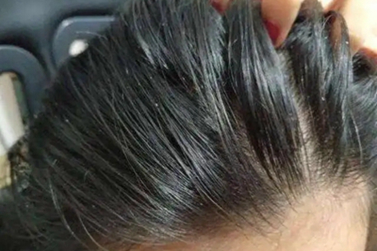 头皮糠疹头皮脱屑图