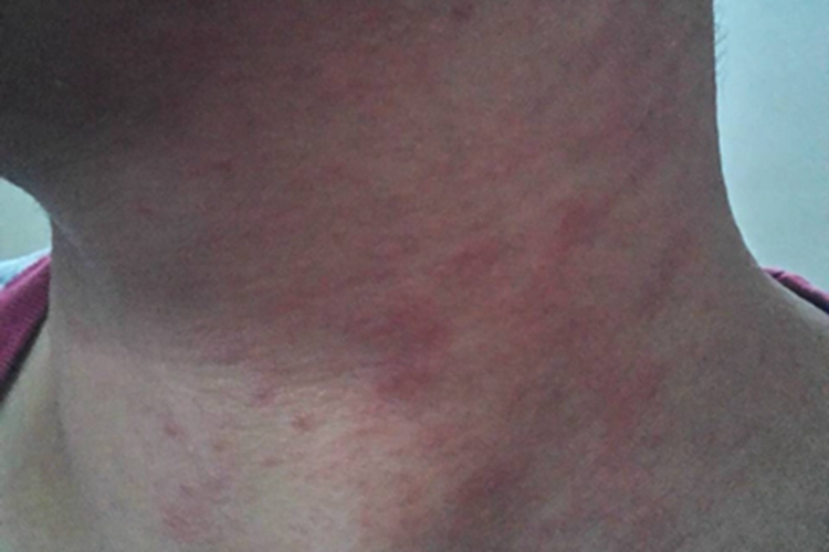 日光性皮炎颈部红斑图