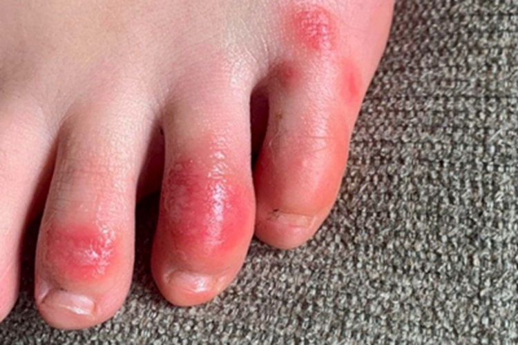 急性一氧化碳中毒脚部红肿图