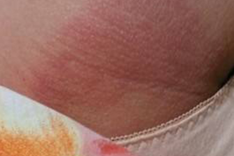 腹股沟过敏性皮炎图