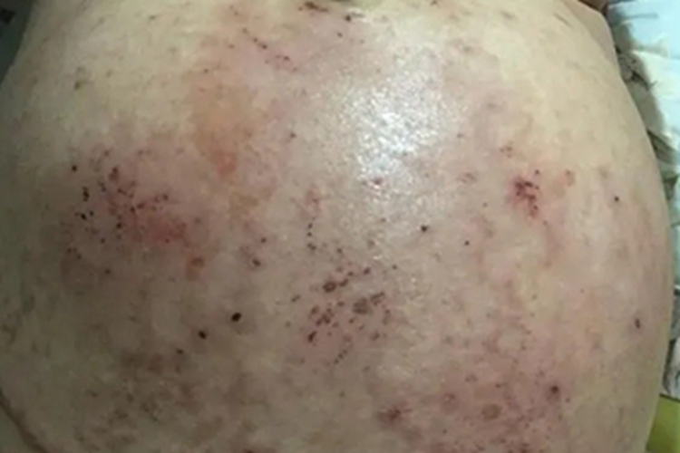 妊娠瘙痒症血痂图