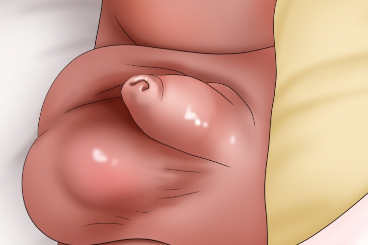 小儿附睾炎阴囊红肿图 小儿附睾炎阴囊红肿图