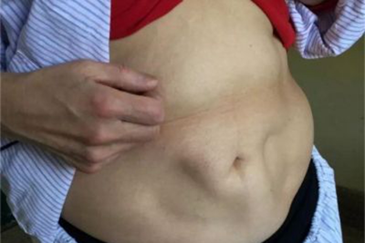 进行性脂肪营养不良皮肤萎缩图