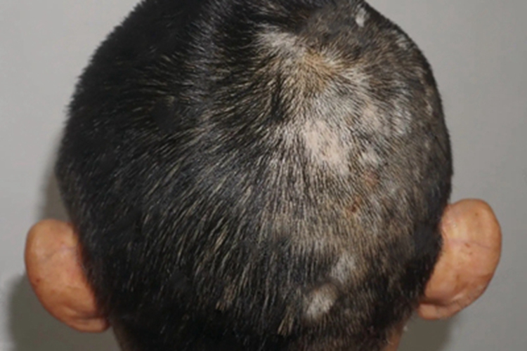 白癜风头皮症状图