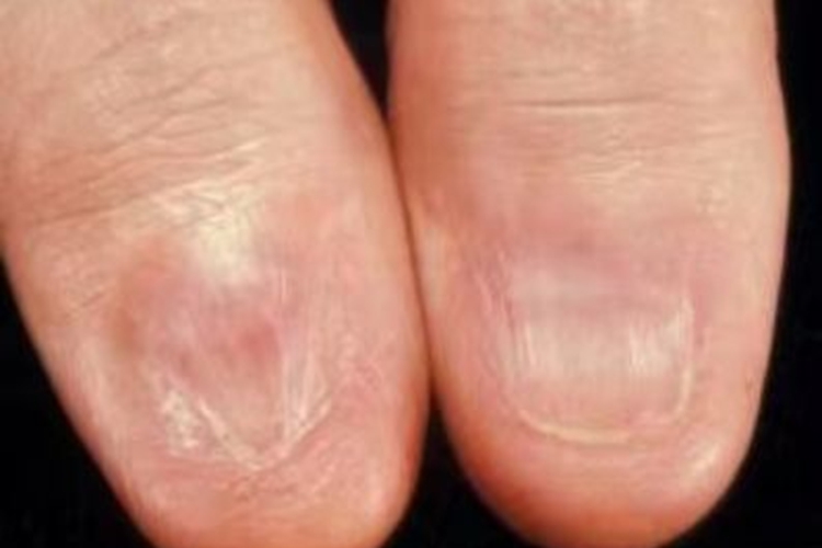 获得性无甲手指甲症状图