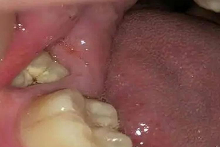 右下颌智齿歪斜图