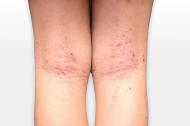 特应性皮炎腘窝小红疙瘩图