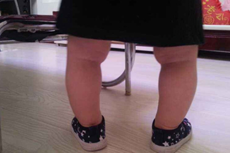 小儿软骨发育不全小腿弯曲图