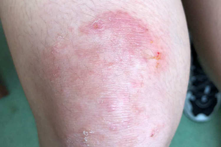 体癣膝盖红斑图
