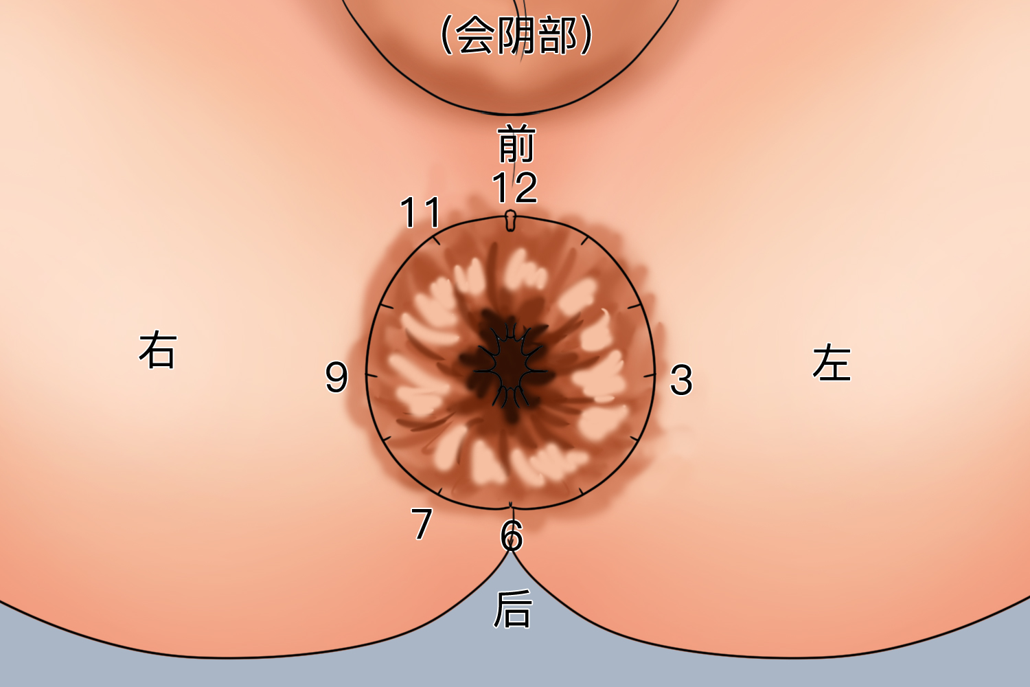 痔疮3点7点11点位置图