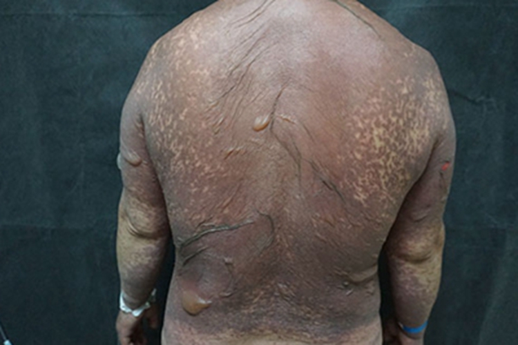 中毒性表皮坏死松解症症状图