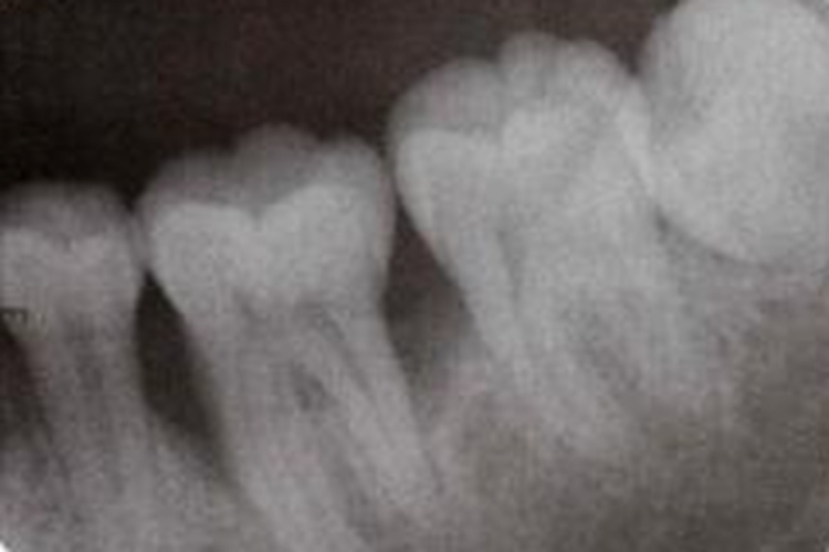 牙槽骨吸收影像图