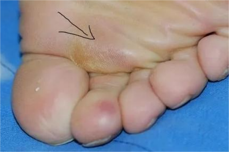 早期胼胝图 早期胼胝图