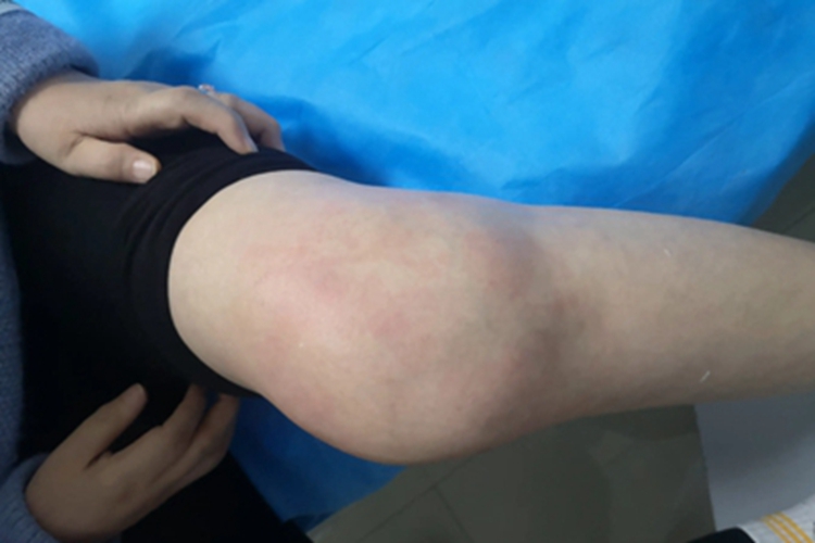 女性二期梅毒膝盖肿图