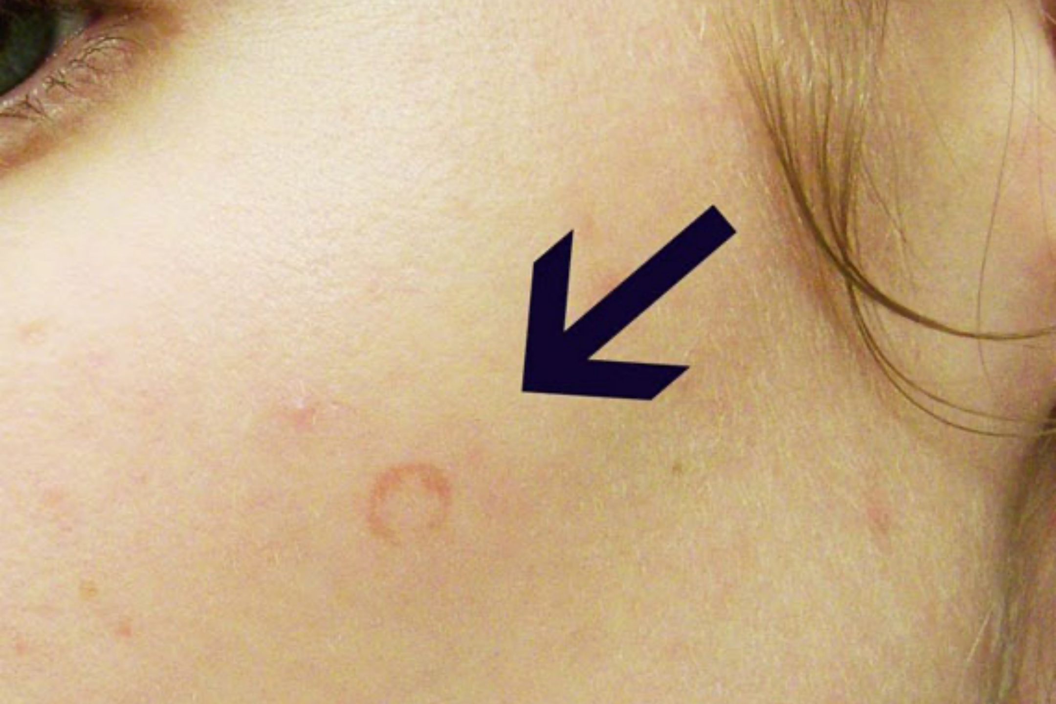 脸上体癣图 脸上体癣图