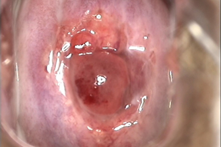 宫颈囊肿宫颈表面有红色肿物图 宫颈囊肿宫颈表面有红色肿物图