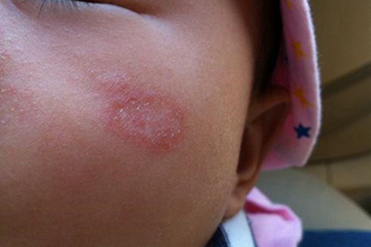 银屑病图 银屑病图